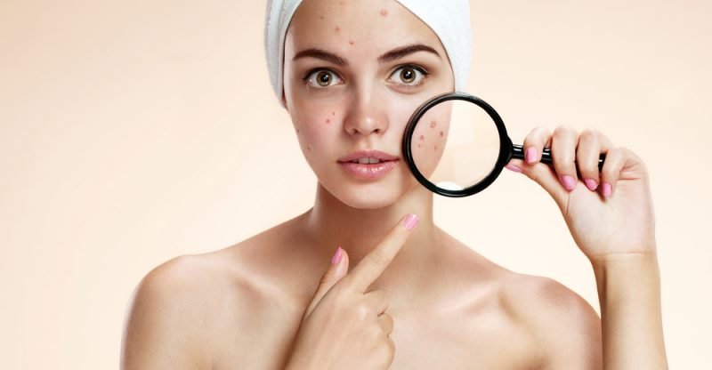 how to get rid of acne quick