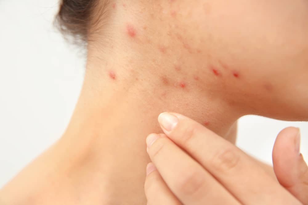 9 Natural Treatments For Scabies Natural Food Series