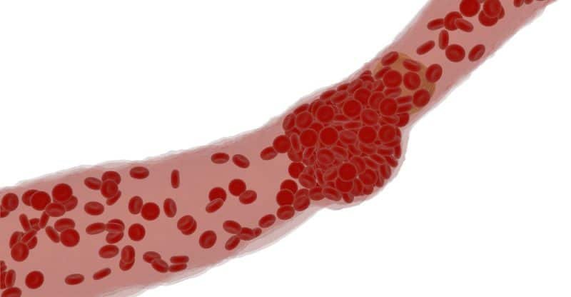 home remedies for blood clots