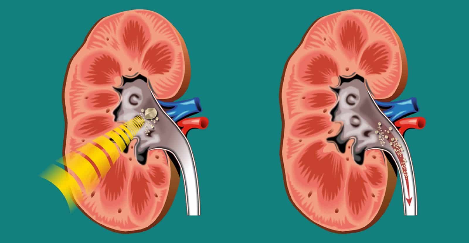 10 Home Remedies For Kidney Stones Natural Food Series