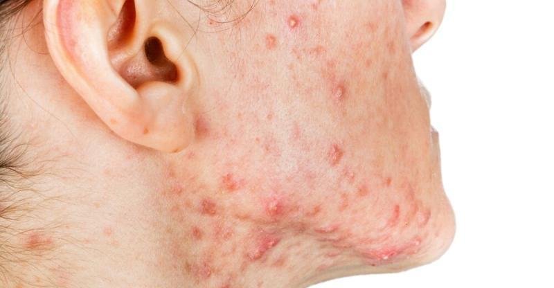 Skin Infection: Types, Causes and Treatments - Natural Food Series